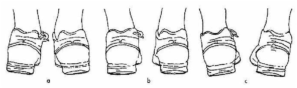 Hình .6.4 Các loại bàn chân: (a) quay sấp, (b) trung tính, (c) ngửa.